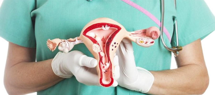 myoma uteri