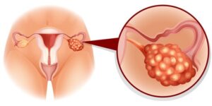 ovarian cyst