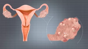 ovarian cyst