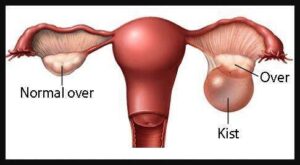 ovarian cyst