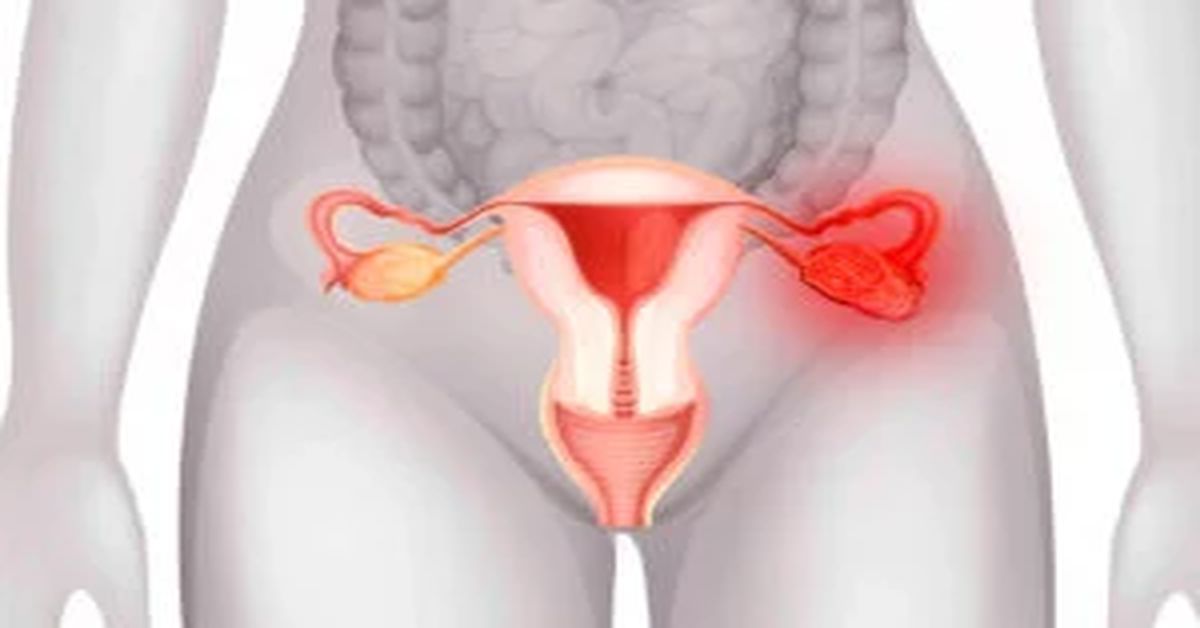 What is Myoma Uteri? What is Myoma Uteri?
