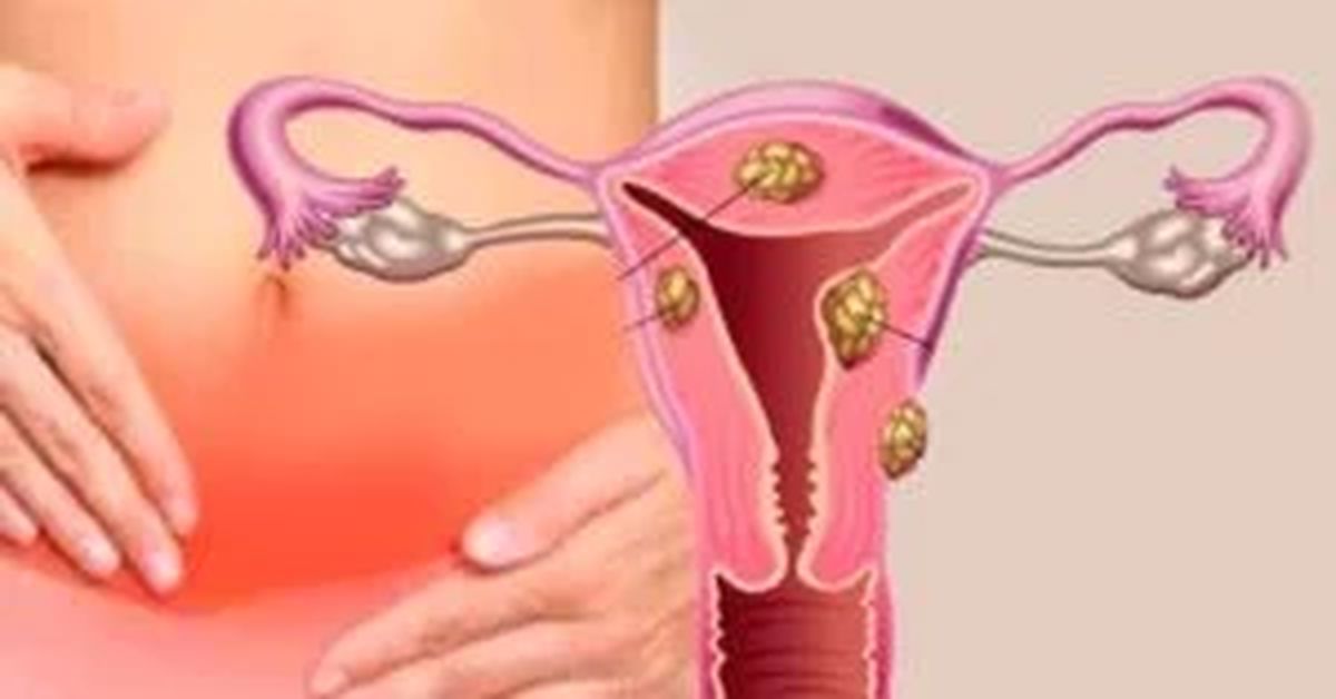 What is Myoma Uteri? What is Myoma Uteri?