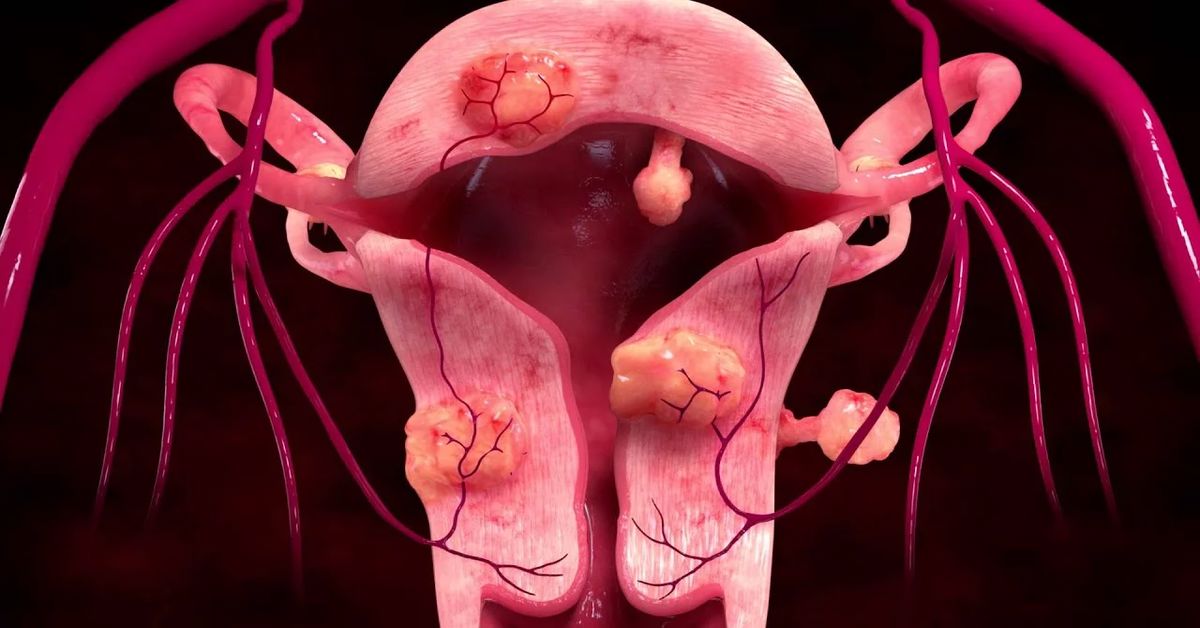 What is Myoma Uteri?
