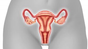 What is Vaginal Prolapse?
