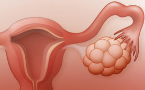 What is Ovarian Cyst Treatment?