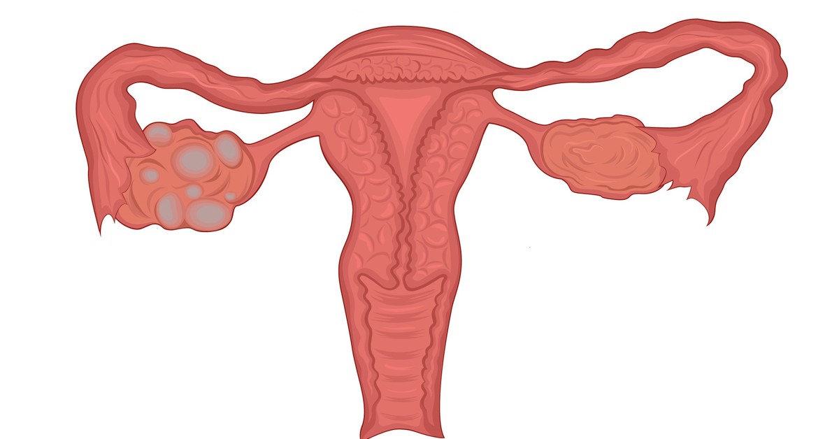 What is Ovarian Cyst Treatment?