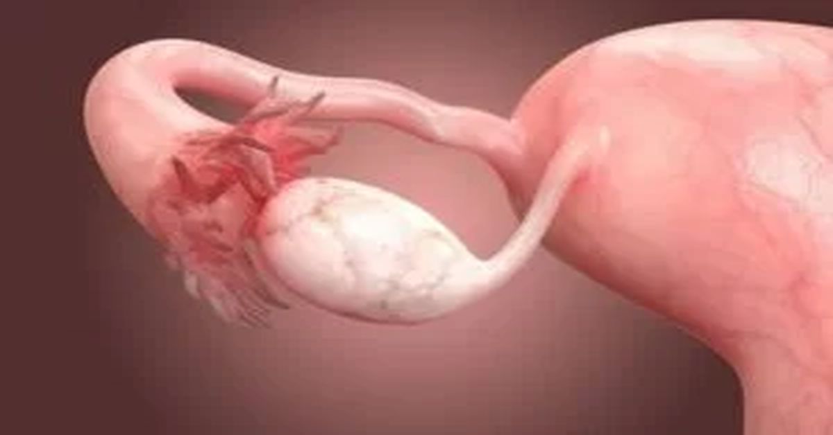 Ovarian Cyst Explosion Ovarian Cyst Explosion