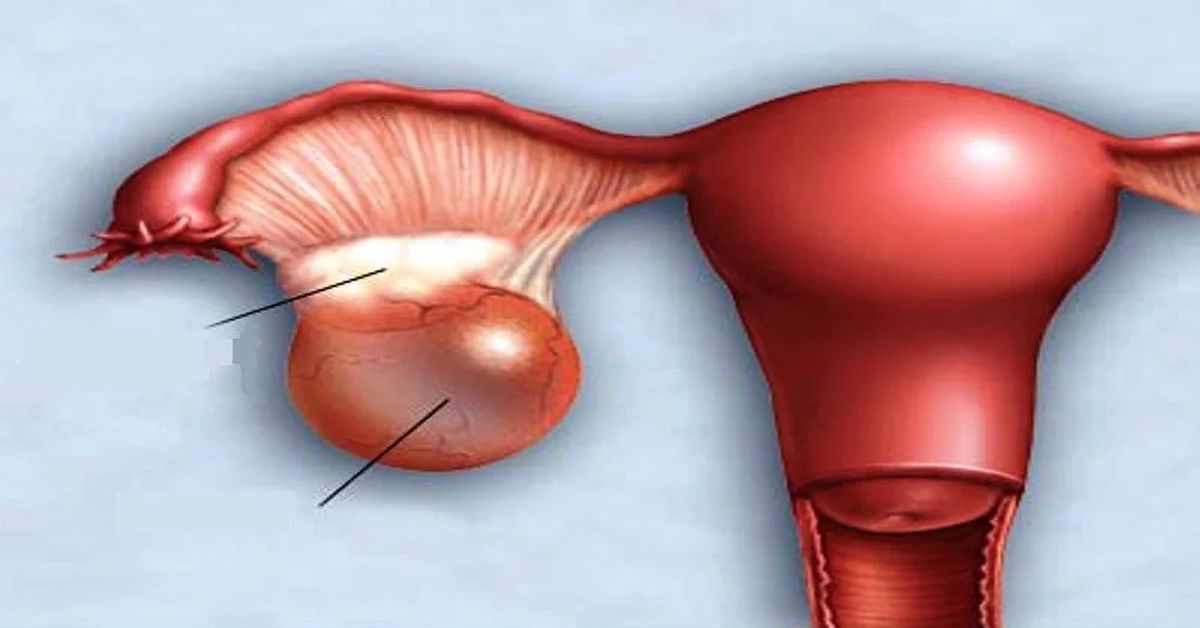Ovarian Cyst Explosion