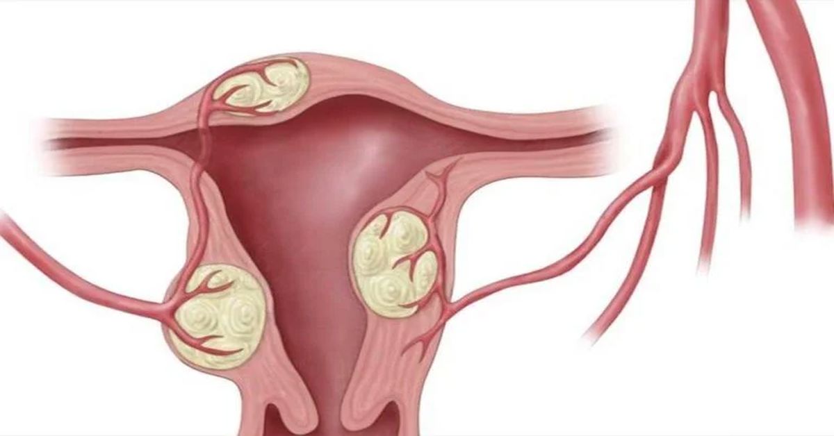 Myoma Uteri Ameliyatı Myoma Uteri Ameliyatı