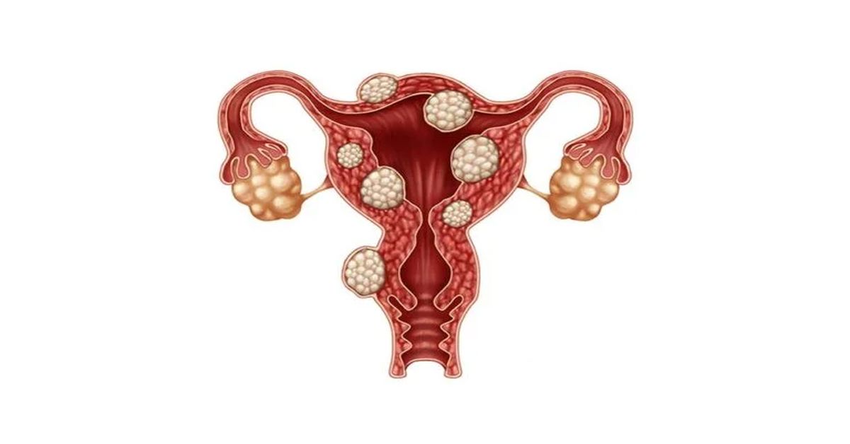 Myoma Uteri Ameliyatı Myoma Uteri Ameliyatı