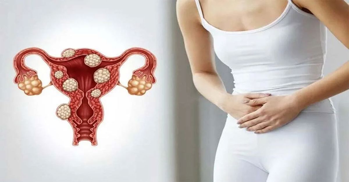 Myoma Uterus Surgery