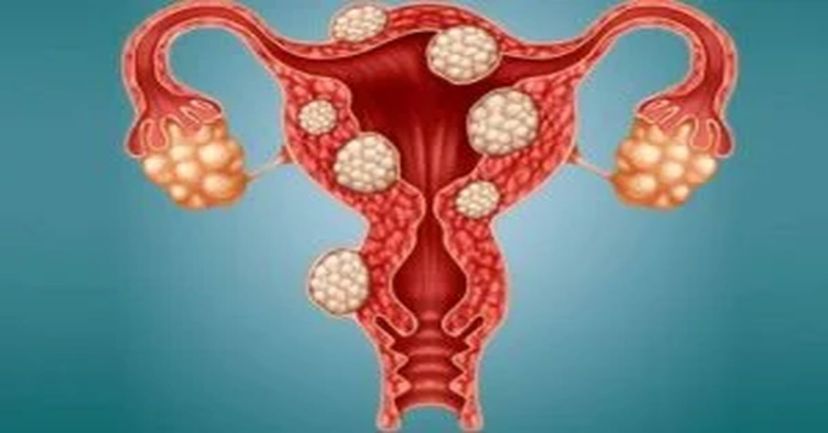 ورم المبيض ورم المبيض