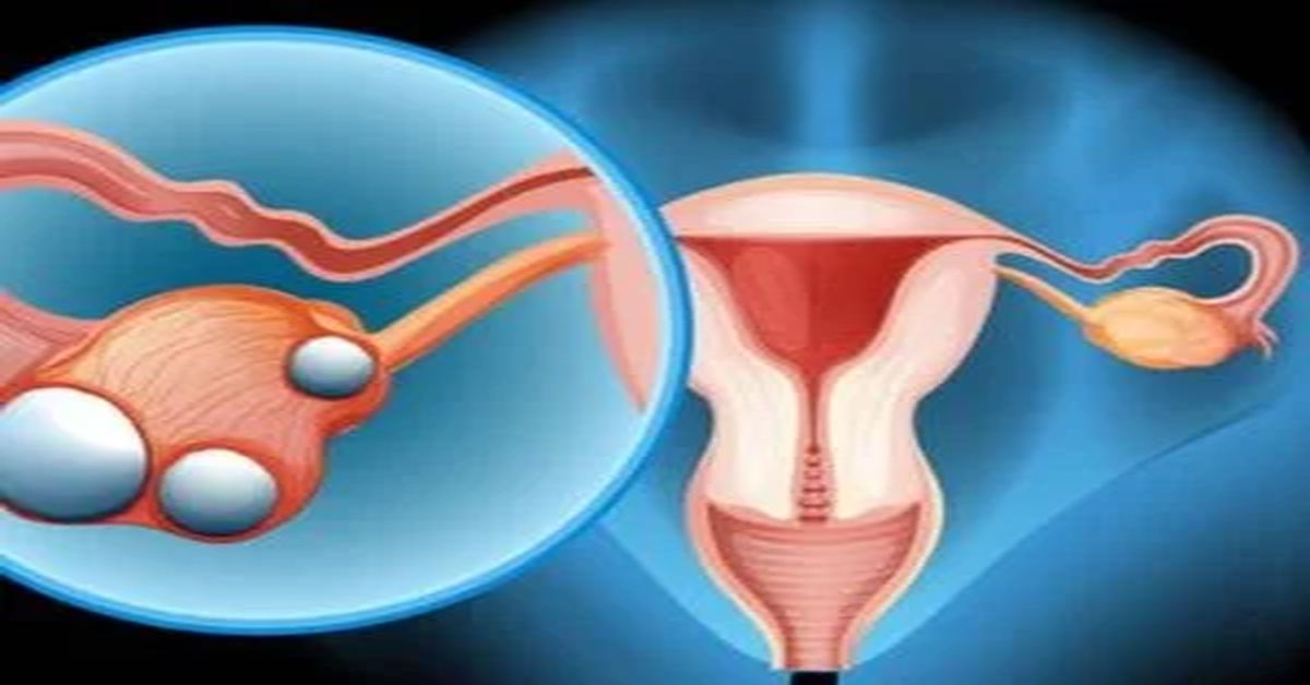 ورم المبيض ورم المبيض