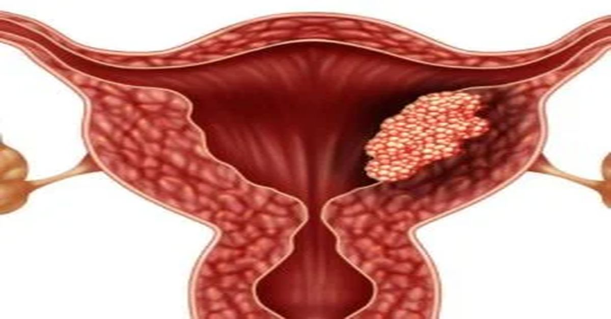 ورم الرحم ورم الرحم