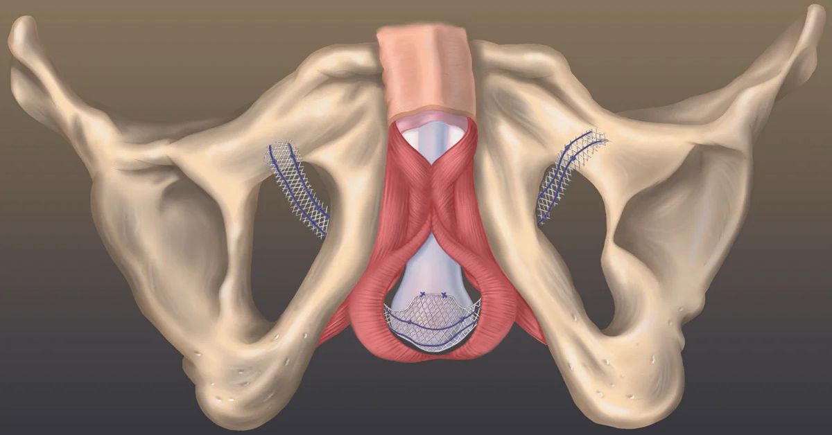 TOT Operasyonu Nedir?