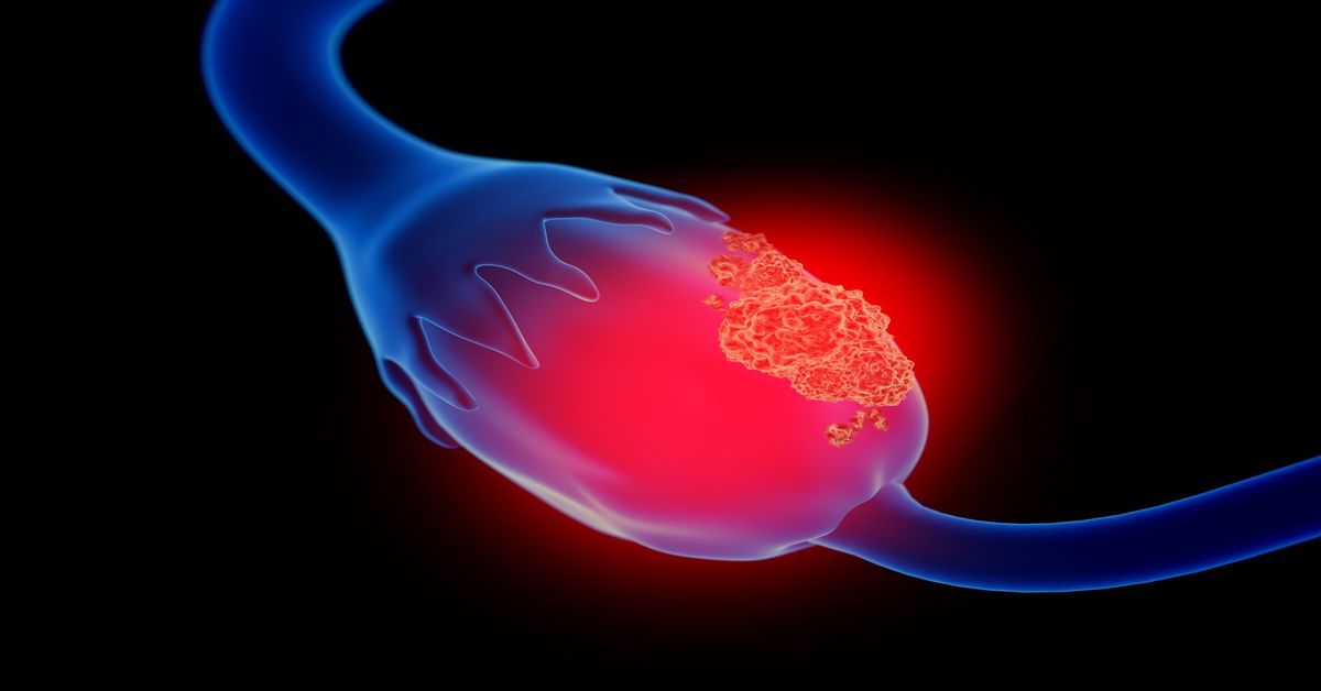 Yumurtalık Tümörü Tedavisi