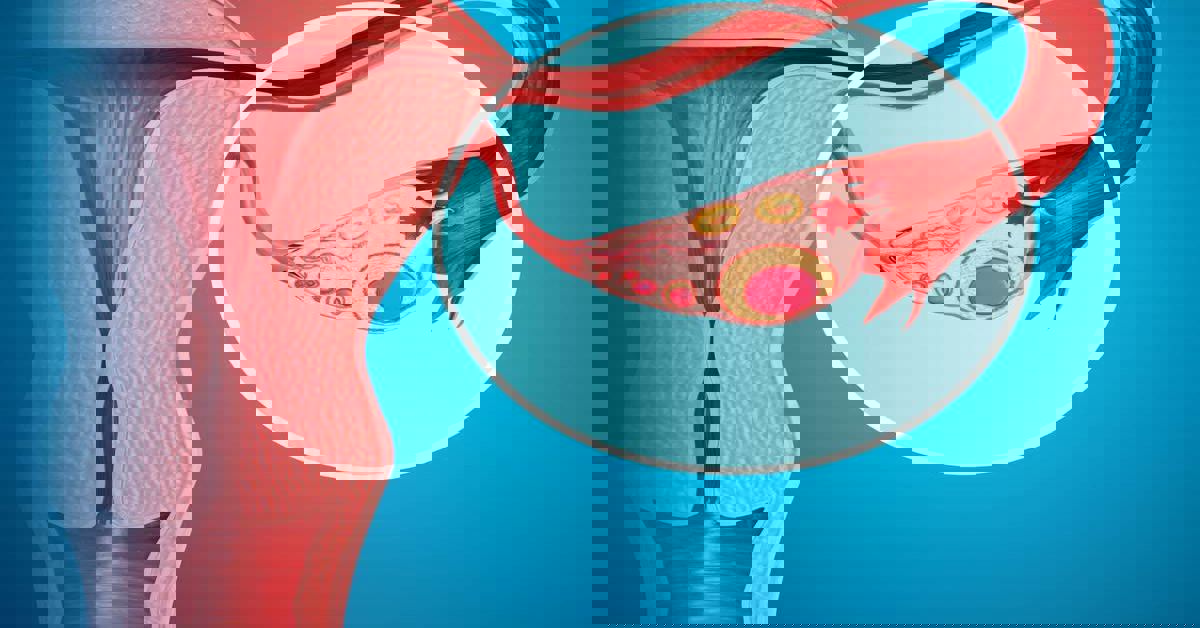 Yumurtalık Tümörü Tedavisi