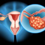 Yumurtalık Tümörü Tedavisi