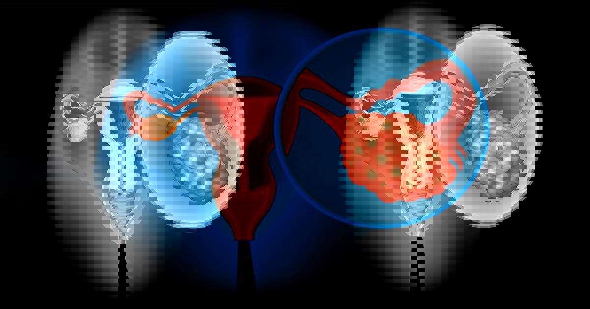 Yumurtalık Tümörü Tedavisi