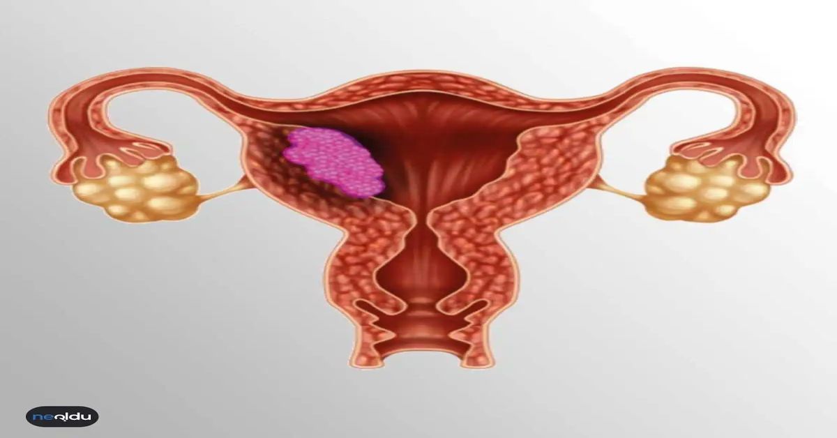 Rahim Tümörü Ameliyatı Rahim Tümörü Ameliyatı