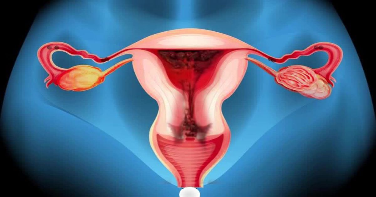 Rahim Tümörü Ameliyatı Rahim Tümörü Ameliyatı