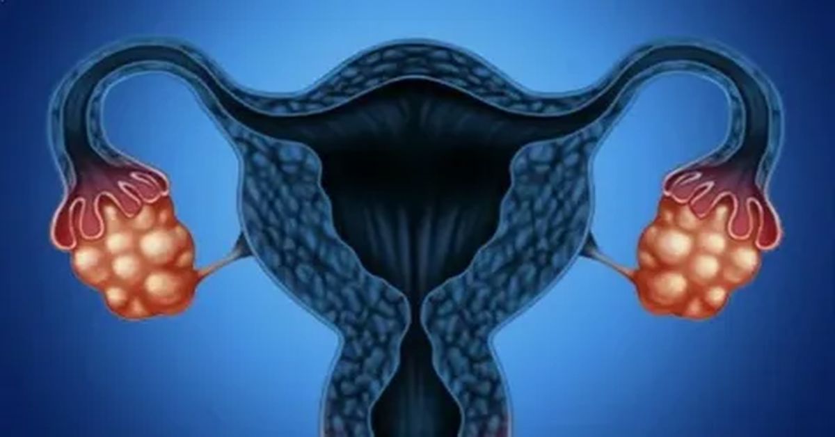 Rahim Tümörü Tedavisi Rahim Tümörü Tedavisi