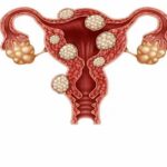 Yumurtalık Kisti Ameliyatı