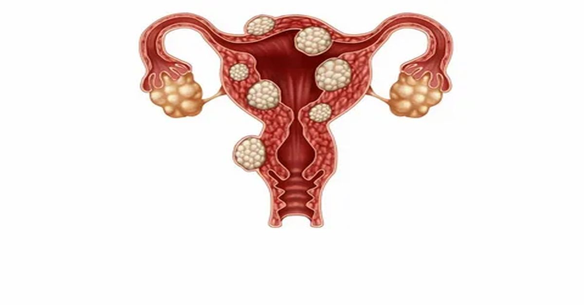 Yumurtalık Kisti Ameliyatı